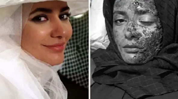 صورت سوخته خانم بازیگر+ عکس