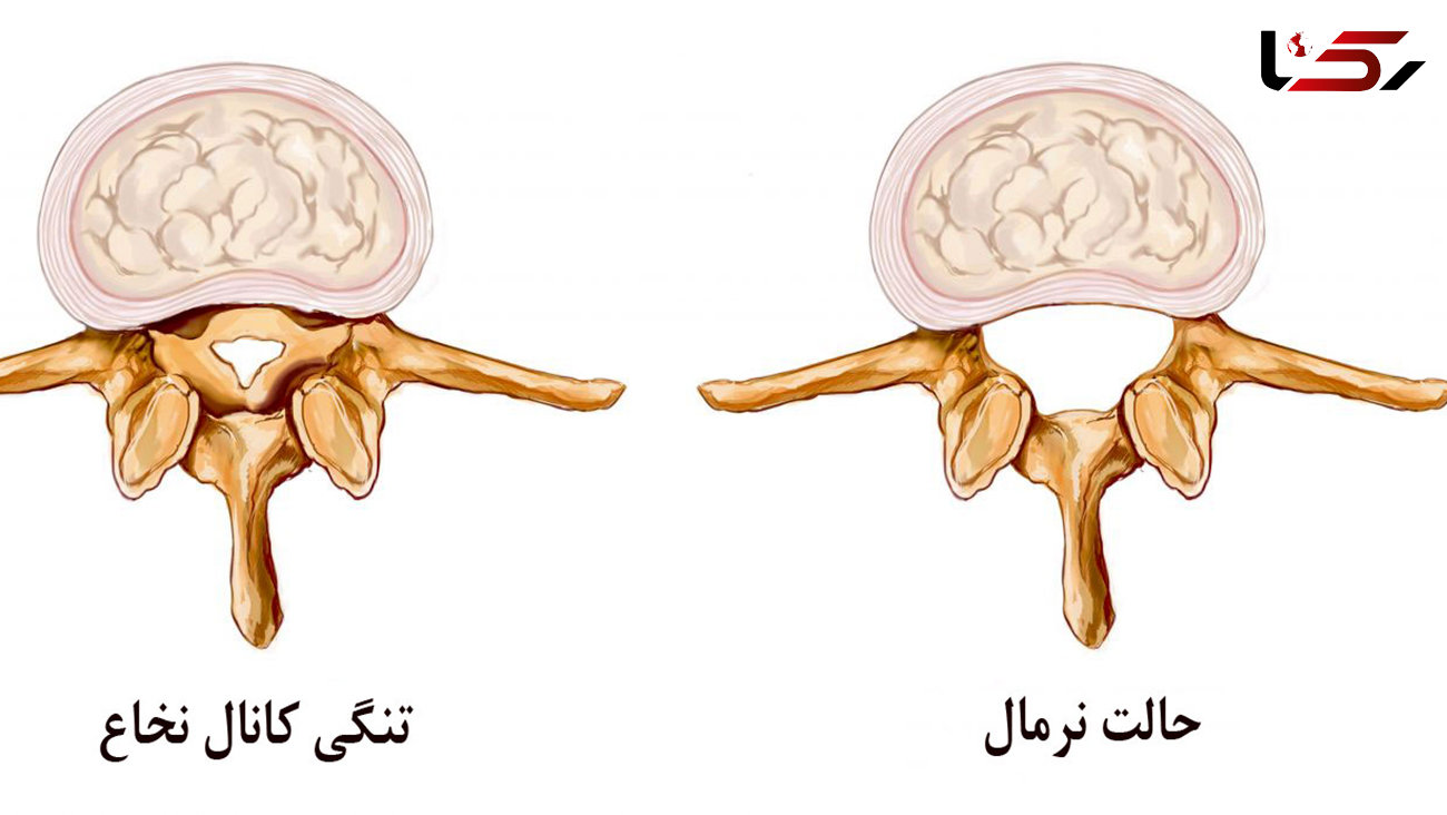 بررسی علت تنگی کانال نخاعی 