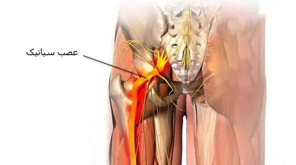 اگر سیاتیک دارید این کارها را نکنید!