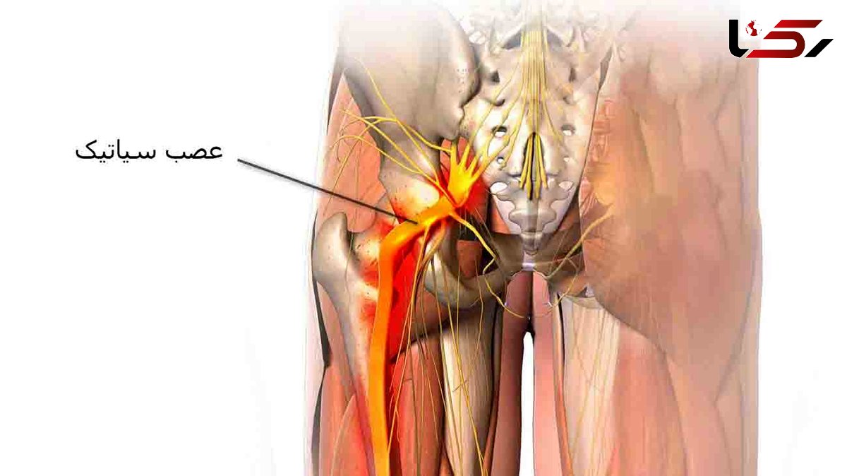 اگر سیاتیک دارید این کارها را نکنید!