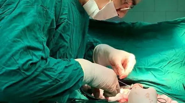 انجام عمل جراحی همی کولکتومی راست (برداشت روده بزرگ) اورژانسی در نوزاد ۵ ماهه در پارس آبادمغان