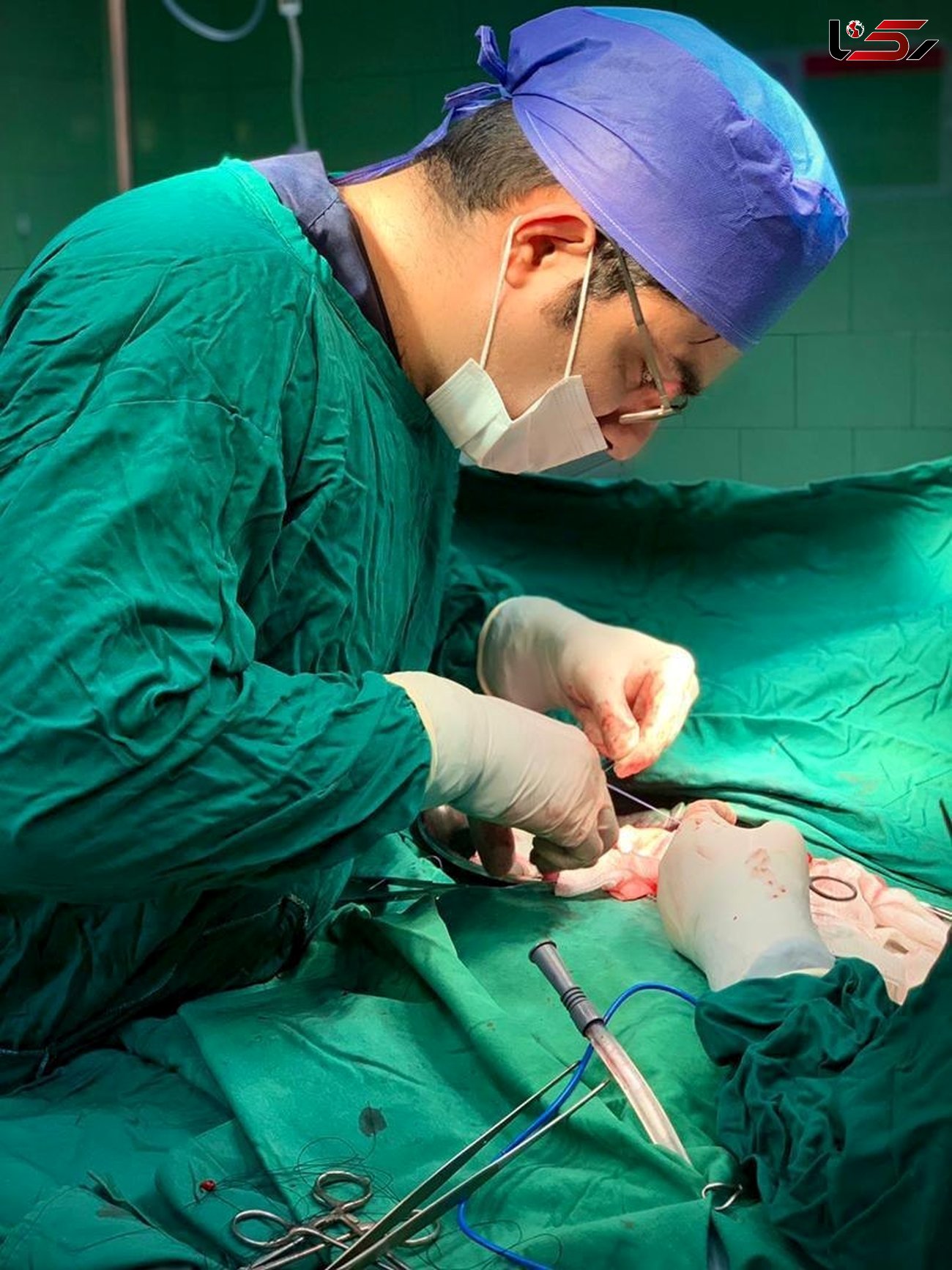 انجام عمل جراحی همی کولکتومی راست (برداشت روده بزرگ) اورژانسی در نوزاد ۵ ماهه در پارس آبادمغان