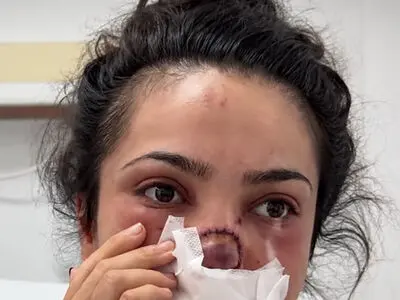 فیلم / شوهر این خانم  از عصبانیت دماغشو گاز گرفت و از جا کند