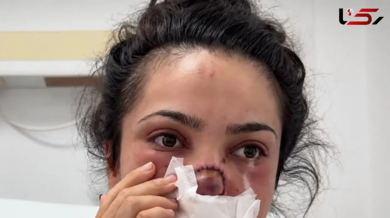 فیلم / شوهر این خانم  از عصبانیت دماغشو گاز گرفت و از جا کند