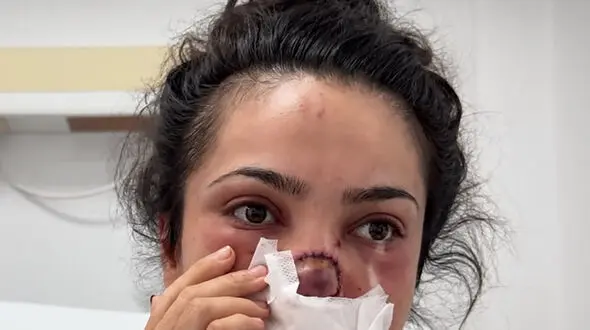 فیلم / شوهر این خانم  از عصبانیت دماغشو گاز گرفت و از جا کند