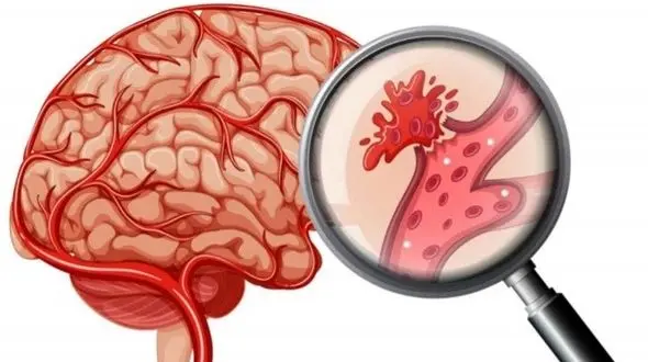 یا میدانید بهترین راه درمان سکته مغزی چیست؟