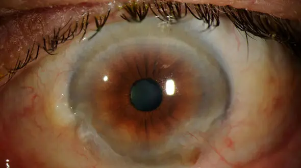 راه های درمانی آب مروارید