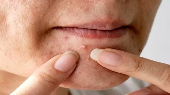 بهترین توصیه‌ها برای خلاص شدن از جوش‌های سرسفید