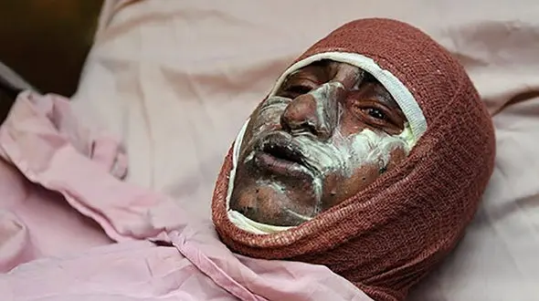 با افراد دچار سوختگی چه کنیم؟