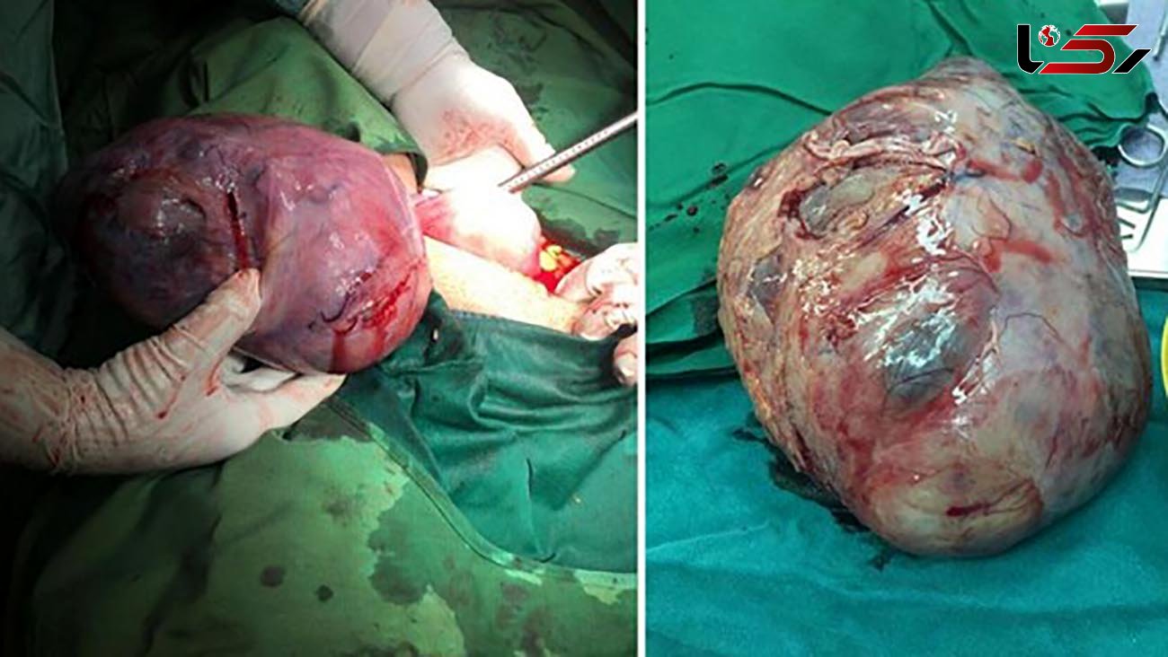 کشفی عجیب در شکم زن جوان قمی / پزشکان شوکه شدند + عکس