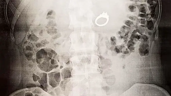 بلعیدن حلقه نامزدی توسط یک زن در خواب/ پزشکان امریکایی شوکه شدند + عکس ها