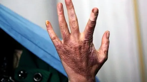 خودسوزی، تصمیم آخر خطی زنان / بازتابی از وضعیت جامعه ای که اقتصاد و روان اجتماعی آرامی ندارد + صوت