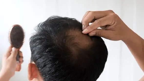 ریزش موی سکه‌ای چیست؟ + درمان خانگی