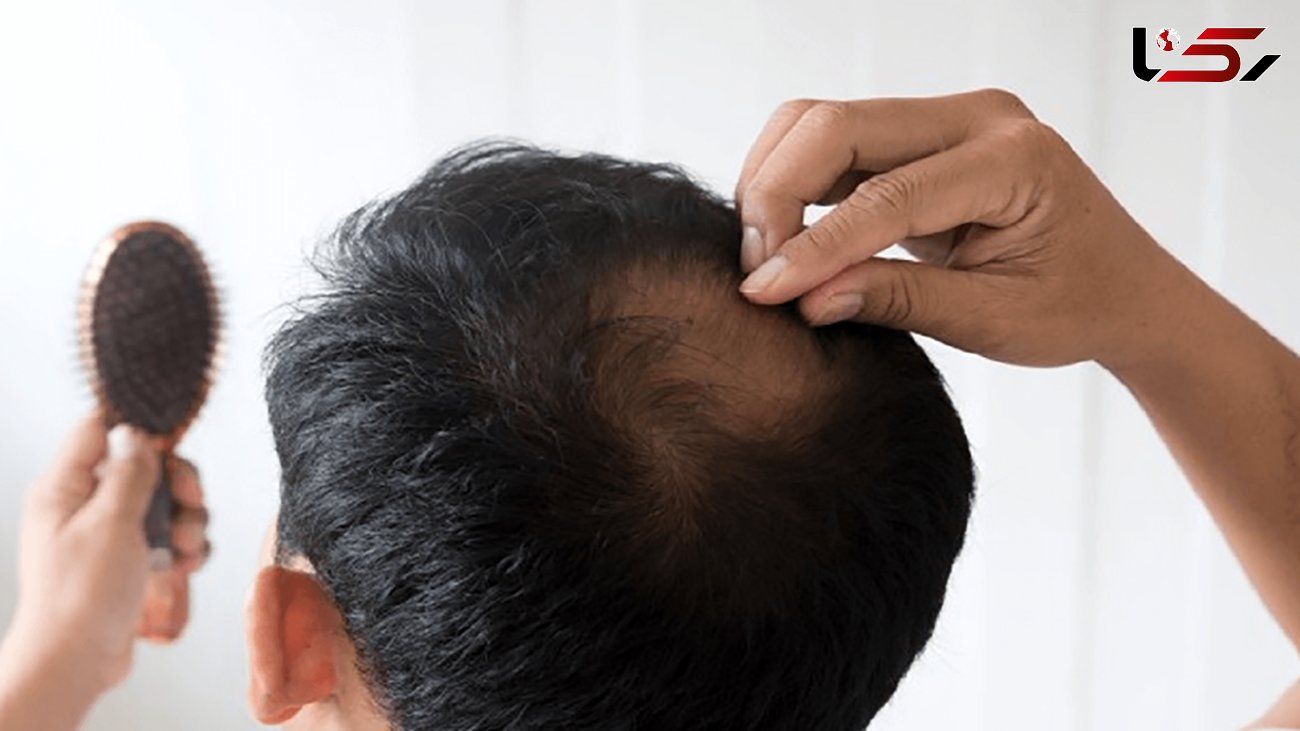 ریزش موی سکه‌ای چیست؟ + درمان خانگی