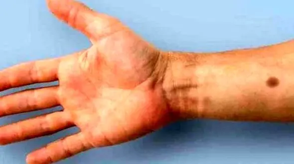 این ایمپلنت با رویش خال ابتلا به سرطان را هشدار می دهد