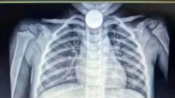 حادثه عجیب و خطرناک برای کودک کرمانشاهی + عملیات ویژه پزشکان 