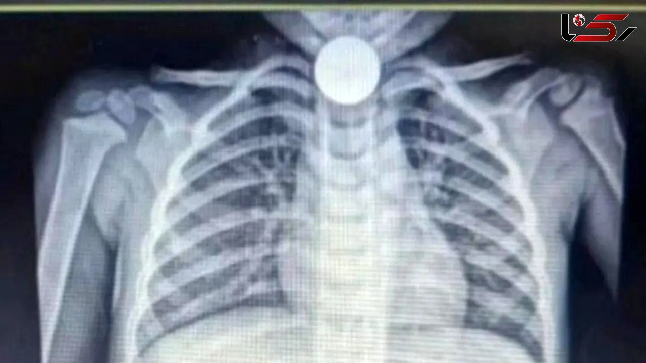 حادثه عجیب و خطرناک برای کودک کرمانشاهی + عملیات ویژه پزشکان 