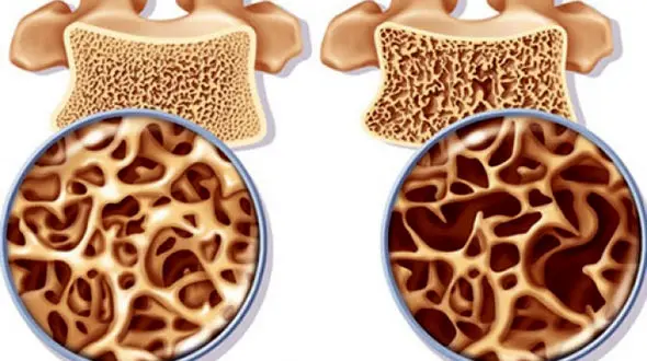 پوکی استخوان را با این مکمل ها مهار کنید
