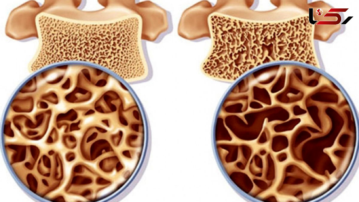 پوکی استخوان را با این مکمل ها مهار کنید