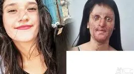 عجیب اما واقعی/ ازدواج  دختر صورت سوخته با عامل اسیدپاشی  / زیبایی چهره عروس خانم قبل اسید سوختگی را ببینید