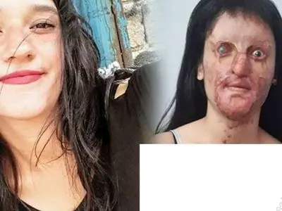 عجیب اما واقعی/ ازدواج  دختر صورت سوخته با عامل اسیدپاشی  / زیبایی چهره عروس خانم قبل اسید سوختگی را ببینید