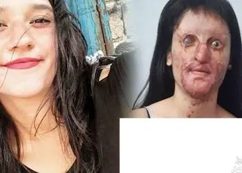 عجیب اما واقعی/ ازدواج  دختر صورت سوخته با عامل اسیدپاشی  / زیبایی چهره عروس خانم قبل اسید سوختگی را ببینید