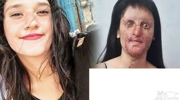 عجیب اما واقعی/ ازدواج  دختر صورت سوخته با عامل اسیدپاشی  / زیبایی چهره عروس خانم قبل اسید سوختگی را ببینید