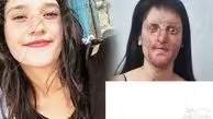 عجیب اما واقعی/ ازدواج  دختر صورت سوخته با عامل اسیدپاشی  / زیبایی چهره عروس خانم قبل اسید سوختگی را ببینید