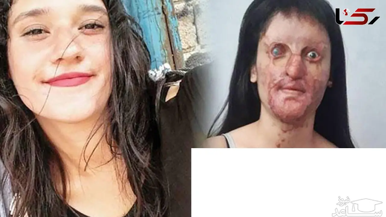عکس / ازدواج جنجالی دختر صورت سوخته با عامل اسیدپاشی روی صورتش / چهره زیبایش قبل اسیدپاشی را ببینید