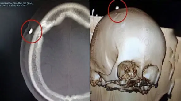 جا ماندن یک دندان در جمجمه پسر 14 ساله + تصویر