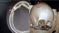 جا ماندن یک دندان در جمجمه پسر 14 ساله + تصویر