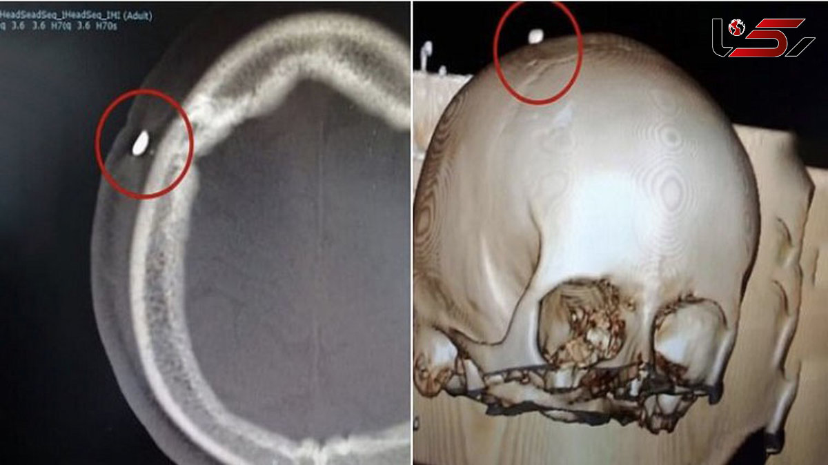 جا ماندن یک دندان در جمجمه پسر 14 ساله + تصویر