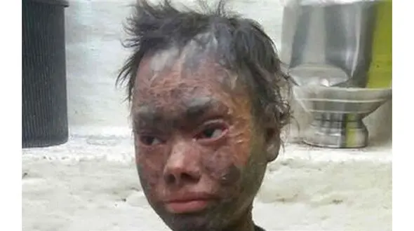 دختری که پوستی شبیه مار دارد +تصاویر 