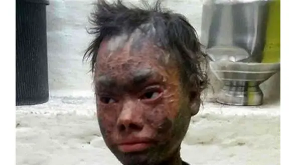 دختری که پوستی شبیه مار دارد +تصاویر 