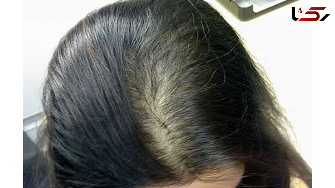 5 راه طبیعی داشتن موهای پرپشت 