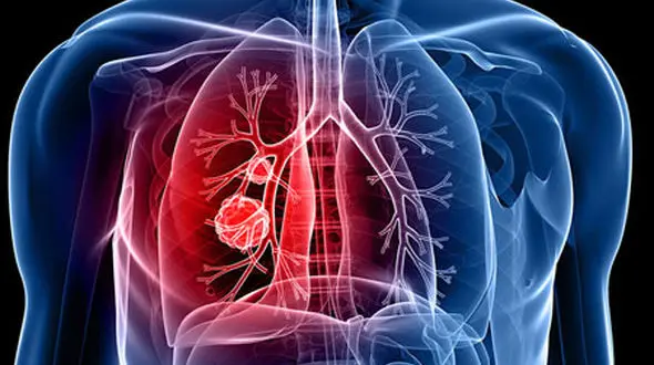 چه زمانی ریه و تنگی نفس کرونایی می شود ؟