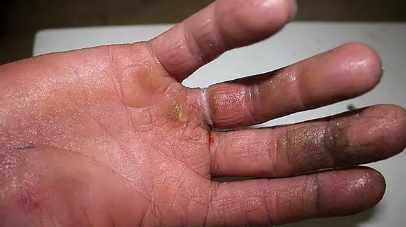 فیلم جذاب ! / ببینید  پرستار انگشتر تنگ رو با چه مهارتی در آورد!