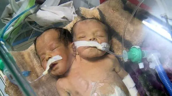 مرگ تلخ دو قلوهای به هم چسبیده / آنها می توانستند زنده بمانند+ عکس