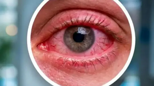 قرمزی چشم بعد از شنا به دلیل کلر نیست!