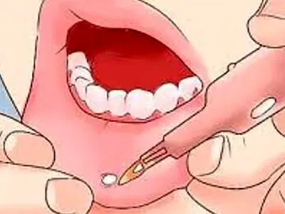 زخم دهان را در خانه درمان کنید؛ چند راهکار ساده و موثر