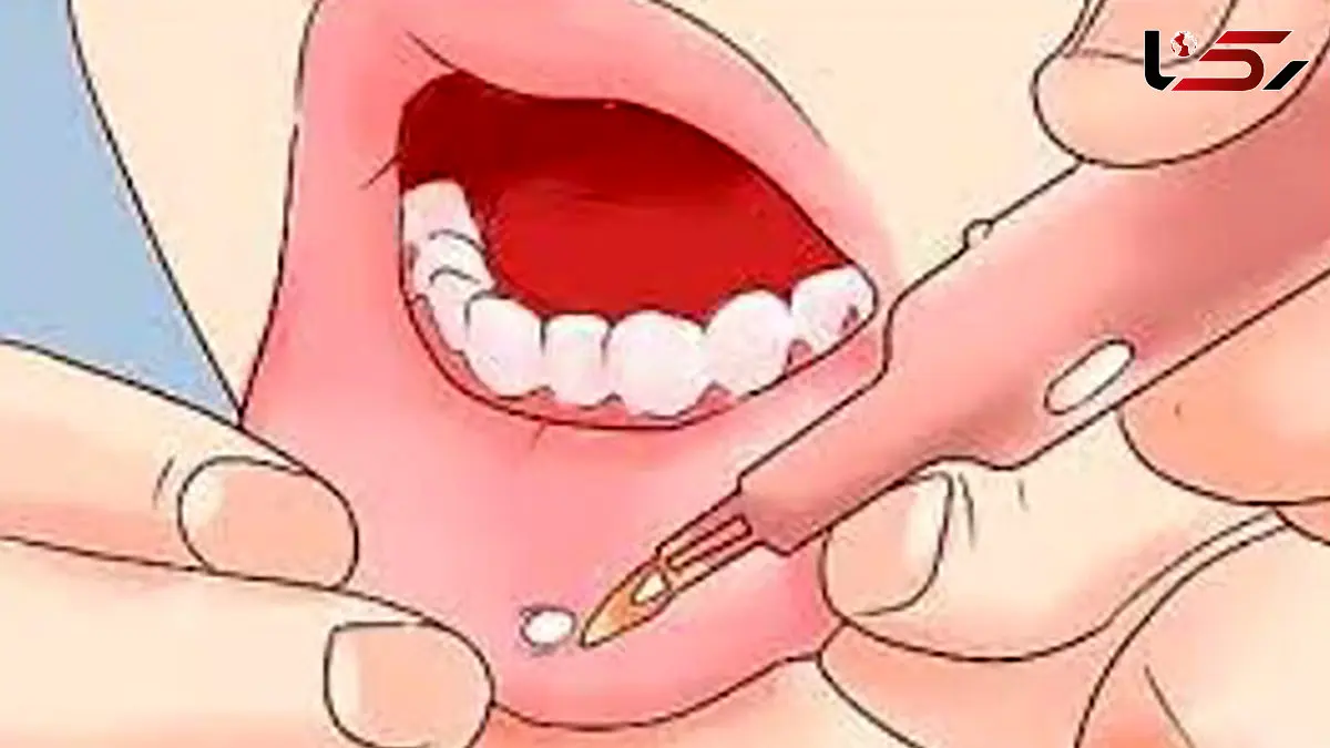 زخم دهان را در خانه درمان کنید؛ چند راهکار ساده و موثر