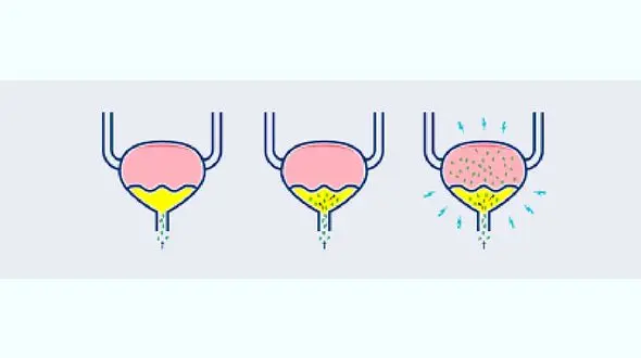 علائم دیابت در ادرار
