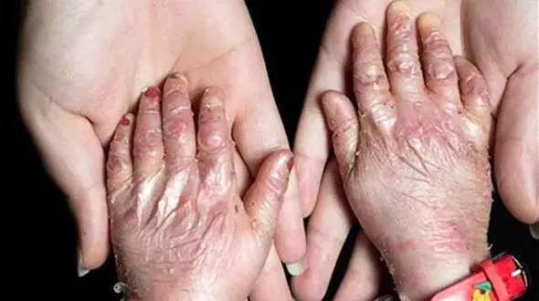 422 بیماری نادر در ایران شناسایی شدند