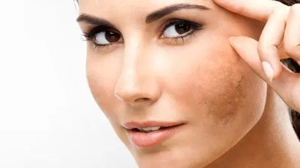 ماسکی که 48 ساعته لکه های قهوه ای پوست را پاک می کند+دستور تهیه