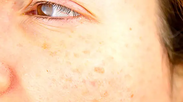 ساده ترین لک بر موثر پوست