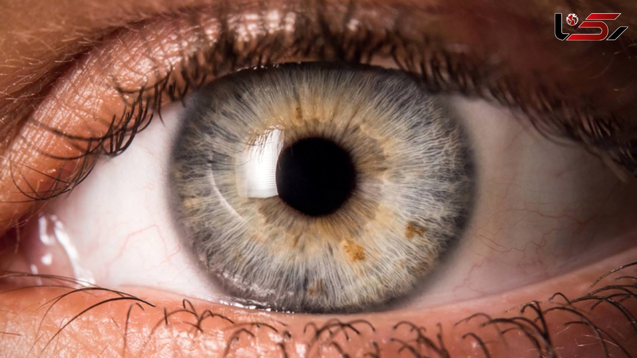 نشانه های یک بیماری چشمی خطرناک