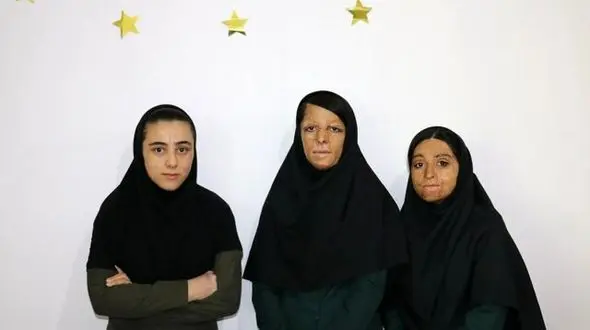 آخرین خبر از دختران سوخته شین آبادی در مدرسه + عکس 