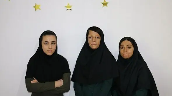 آخرین خبر از دختران سوخته شین آبادی در مدرسه + عکس 