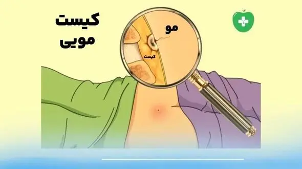 کیست مویی ؛ بیماری خاموش نشیمنگاهی و روش‌های قطعی درمان