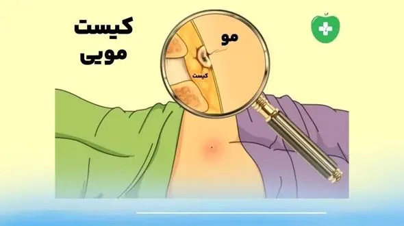 کیست مویی ؛ بیماری خاموش نشیمنگاهی و روش‌های قطعی درمان
